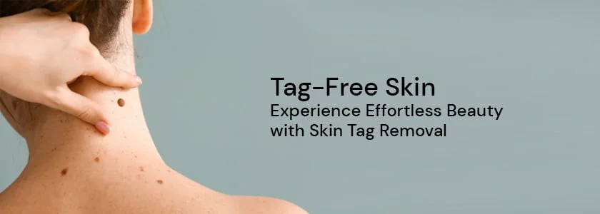 Skin Tag Removal - Scope Cosmetics Surgery Skin Tag Removal - Scope Cosmetics Surgery